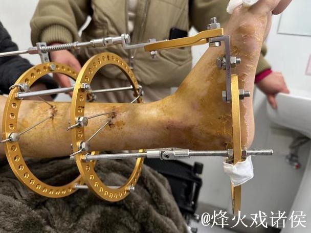 拜仁中场托利索接受脚踝手术